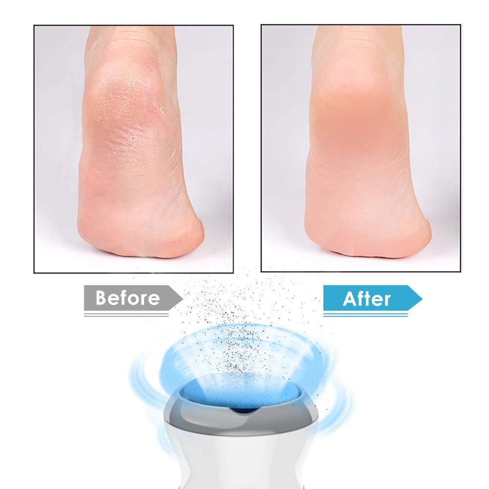 ZenCall Remover - Electric Callus Remover and Vacuum